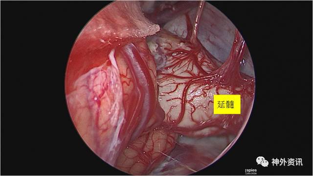 焕新听力之旅：最新胆脂瘤手术费用一览